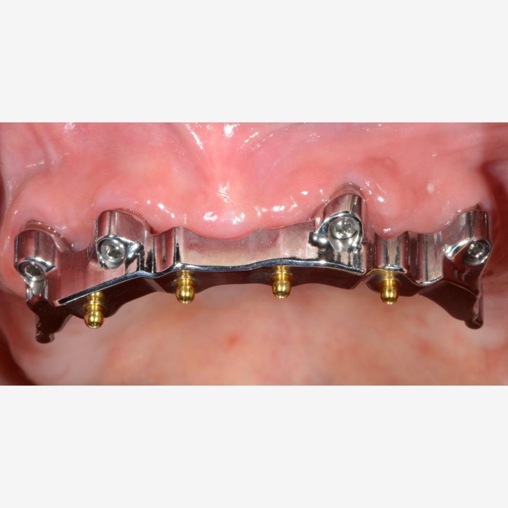 Overdenture su barra | It Dental